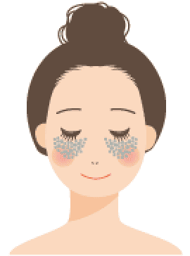 後天性真皮メラノサイトーシス（ＡＤＭ）